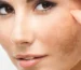 hyperpigmentation