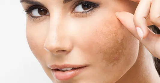 hyperpigmentation